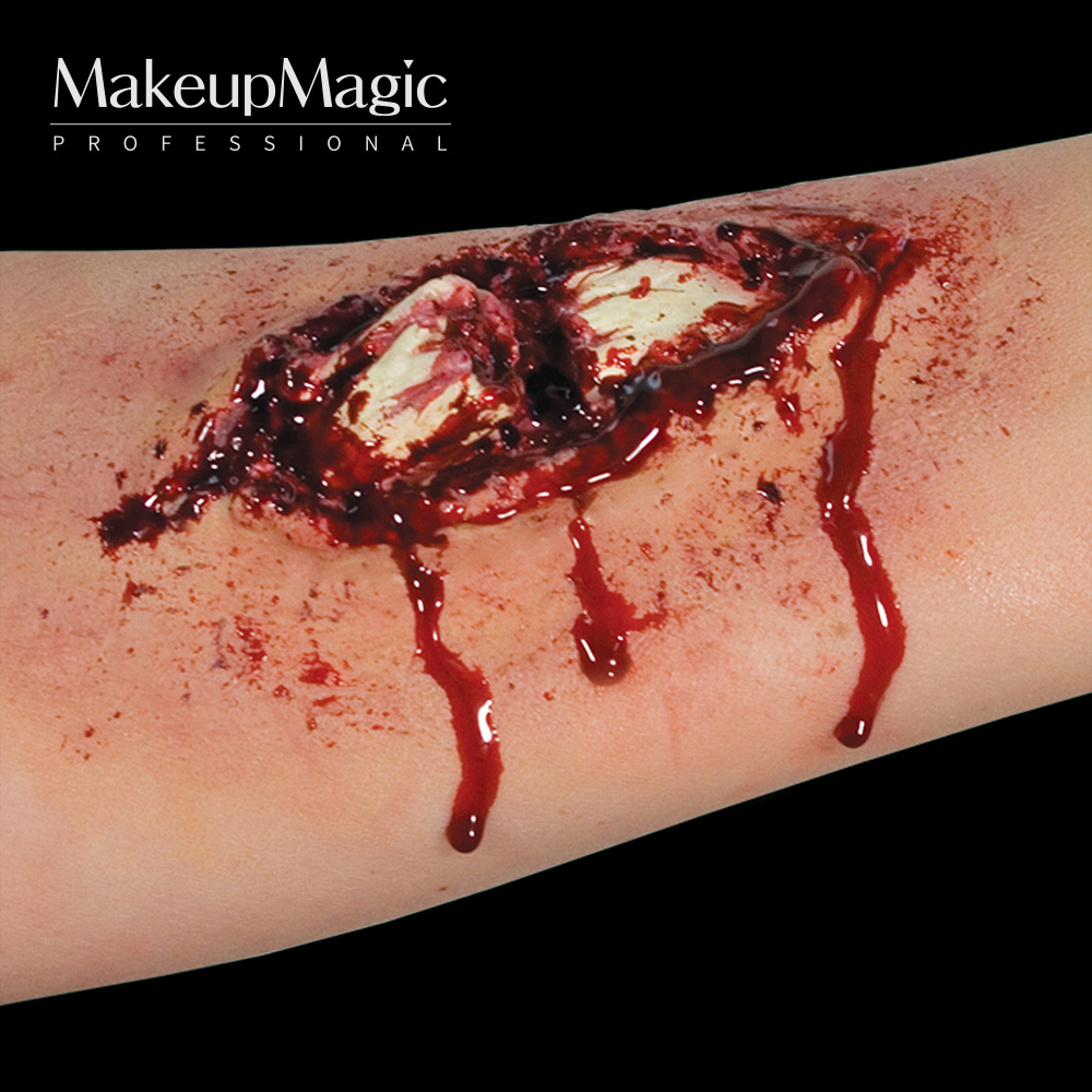 Broken Bone 골절 163